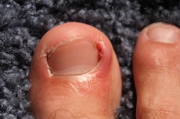 How to Prevent Ingrown Toenails