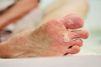 Dealing With Plantar Warts