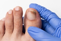 Ways to Treat Toenail Fungus