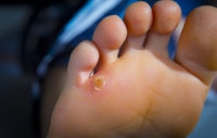 What to Do About Corns on the Feet