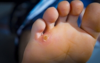 What to Do About Corns on the Feet