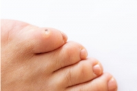 Three Types of Corns on the Feet