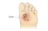 Types of Diabetic Foot Ulcers
