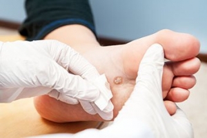 Triggers of Plantar Warts